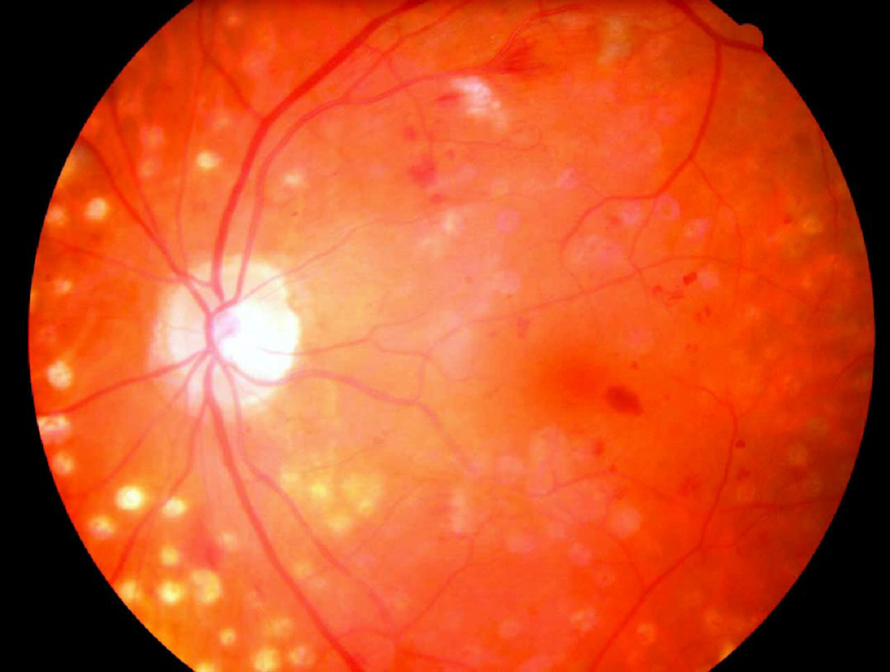 Bild Diabetische_Retinopathie