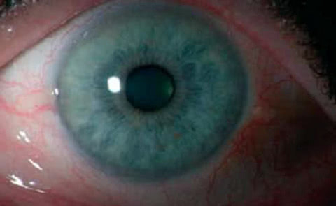 Bild Trockenes_Auge